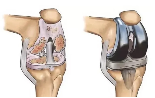 Pre-Surgery Evaluation: What Patients Should Know Before Joint Replacement